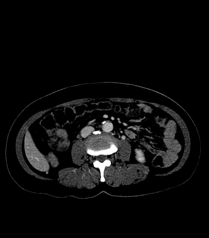 Aortic dissection with renal ischemia (Radiopaedia 76573-88338 B 44).jpg