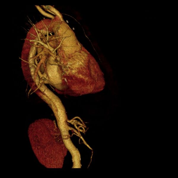 File:Aortic dissection with rupture into pericardium (Radiopaedia 12384-12647 D 10).jpg