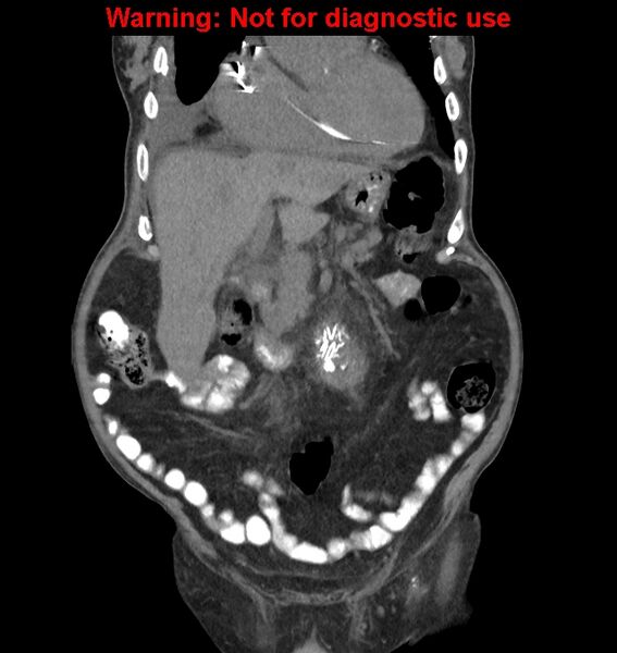 File:Aortic graft infection (Radiopaedia 44979-48907 non-contrast 17).jpg