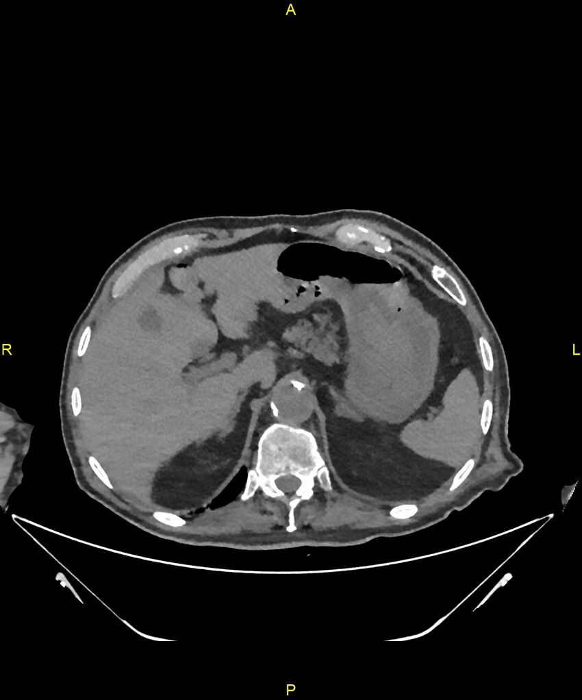 Aortoenteric fistula (Radiopaedia 84308-99603 Axial non-contrast 66).jpg