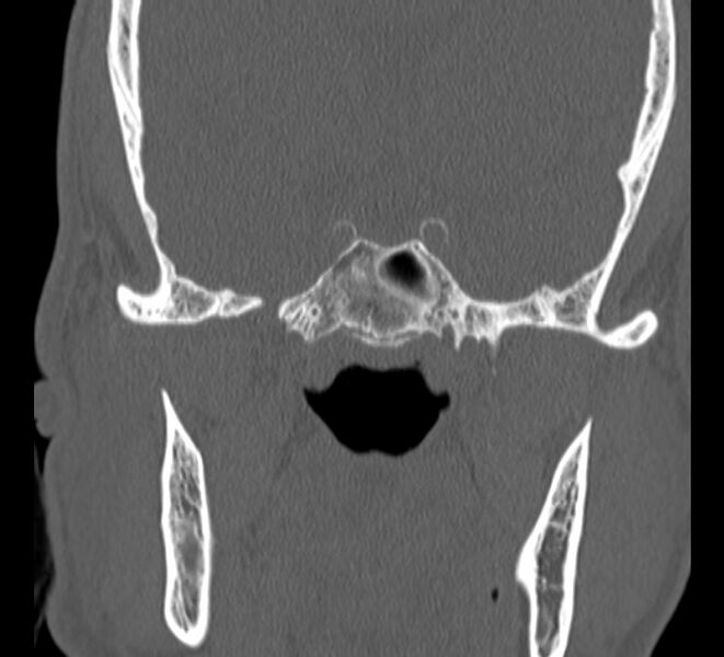 File:Aplastic maxillary sinuses (Radiopaedia 60030-67561 Coronal non-contrast 36).jpg