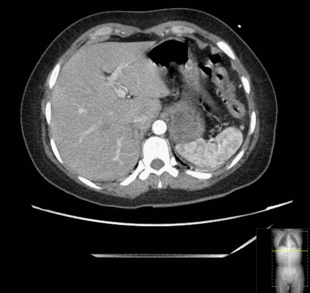 File:Appendicitis (CT angiogram) (Radiopaedia 154713-127660 Axial 160).jpg