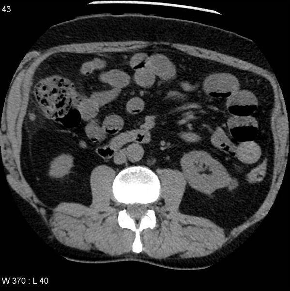 File:Appendicitis (Radiopaedia 12510-12733 Axial non-contrast 10).jpg