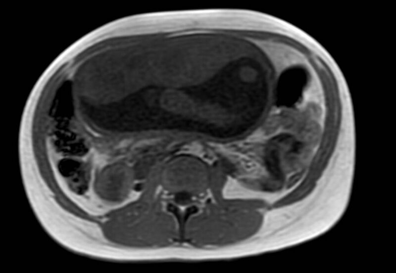File:Appendicitis in gravida (MRI) (Radiopaedia 89433-106395 Axial T1 in-phase 31).jpg