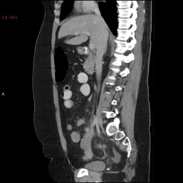 File:Appendicitis with microperforation- promontoric type (Radiopaedia 27268-27442 A 19).jpg