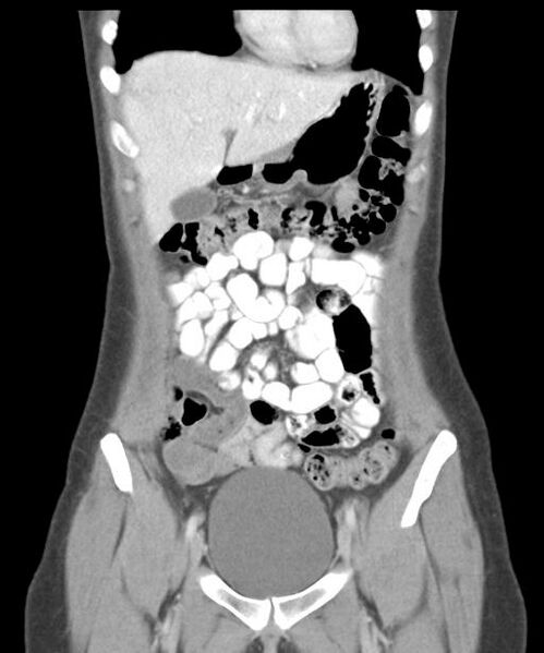 File:Appendicitis with minimal stranding but appendicolith (Radiopaedia 29035-29397 B 13).jpg
