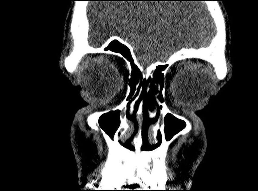 Arachnoid cyst- extremely large (Radiopaedia 68741-78450 Coronal bone window 62).jpg