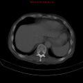 Arachnoiditis ossificans (Radiopaedia 51394-57136 Axial bone window 2).jpg