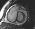 Arrhythmogenic right ventricular cardiomyopathy (Radiopaedia 69431-79307 Short axis cine 176).jpg