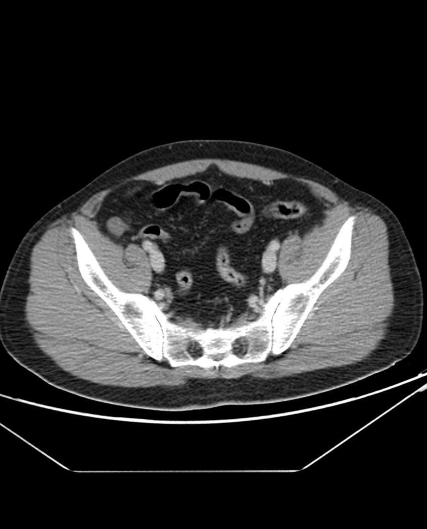 Arterial occlusive mesenteric ischemia (Radiopaedia 84641-100054 A 98).jpg