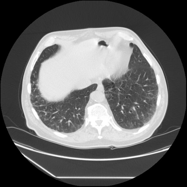 File:Asbestosis complicated by lung cancer (Radiopaedia 45834-50116 Axial lung window 55).jpg