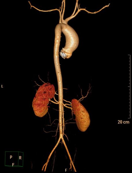 File:Ascending aortic pseudoaneurysm (Radiopaedia 28638-28910 D 15).jpg