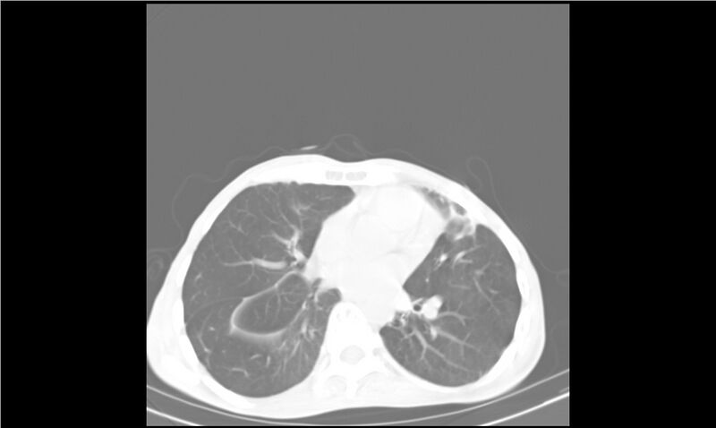 File:Aspergilloma (Radiopaedia 20788-20701 Axial lung window 21).jpg