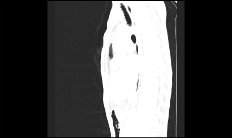File:Aspergilloma (Radiopaedia 20788-20701 Sagittal lung window 10).jpg