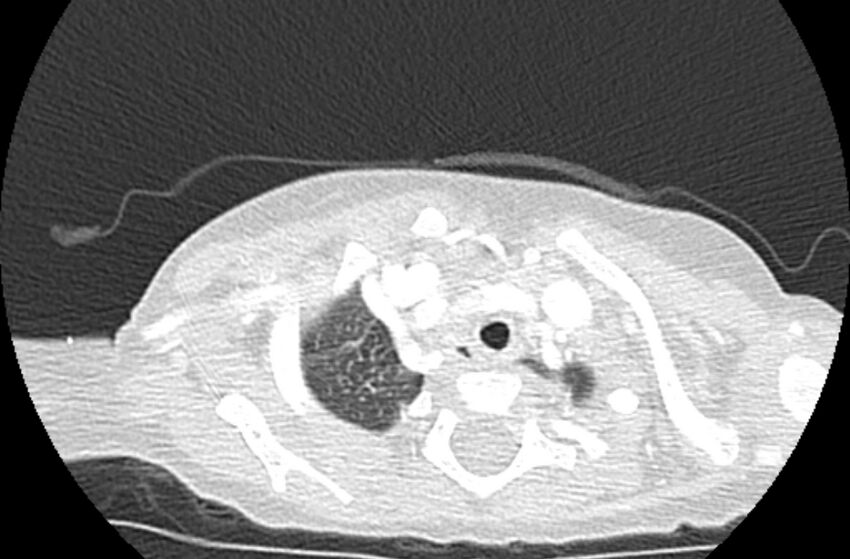 Asplenia syndrome (Radiopaedia 73083-83792 Axial lung window 6).jpg