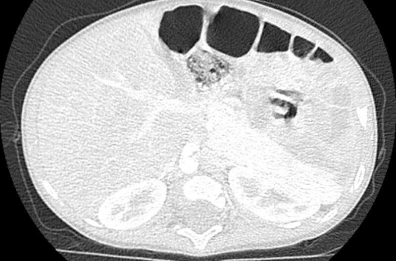 File:Asplenia syndrome (Radiopaedia 73083-83792 Axial lung window 81).jpg