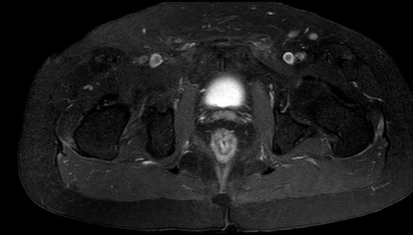 Atypical lipomatous tumor - thigh (Radiopaedia 68975-78734 Axial T1 C+ fat sat 89).jpg