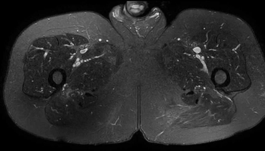 Atypical lipomatous tumor - thigh (Radiopaedia 68975-78734 Axial T2 fat sat 73).jpg