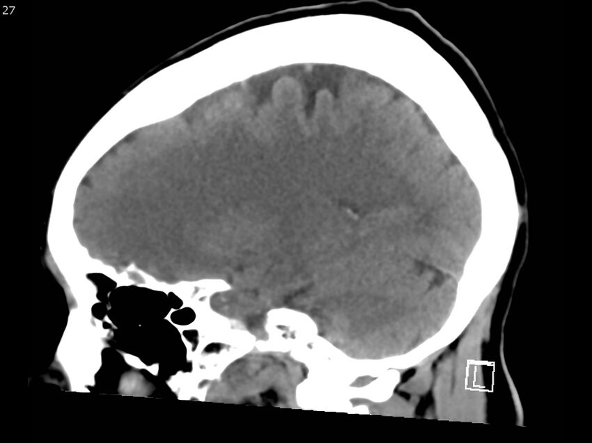Atypical meningioma - intraosseous (Radiopaedia 64915-73867 C 25).jpg