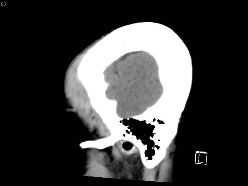 File:Atypical meningioma - intraosseous (Radiopaedia 64915-73867 C 55).jpg