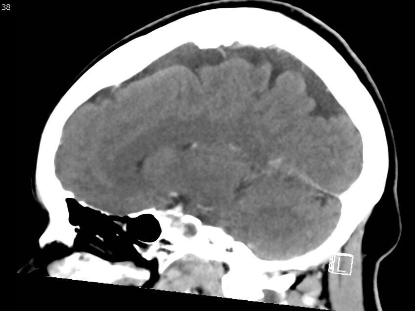Atypical meningioma - intraosseous (Radiopaedia 64915-73867 F 37).jpg