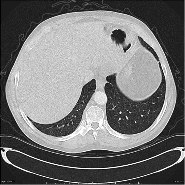 File:Atypical pneumonia - Q fever (Radiopaedia 21993-21989 lung window 42).jpg