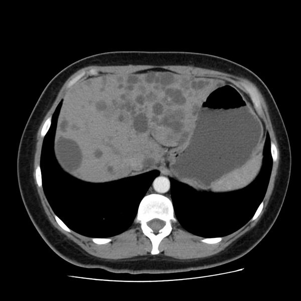 File:Autosomal dominant polycystic kidney disease (Radiopaedia 23061-23093 B 13).jpg
