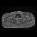 Avascular necrosis of the hip (Radiopaedia 29563-30067 Axial T1 C+ fat sat 9).jpg