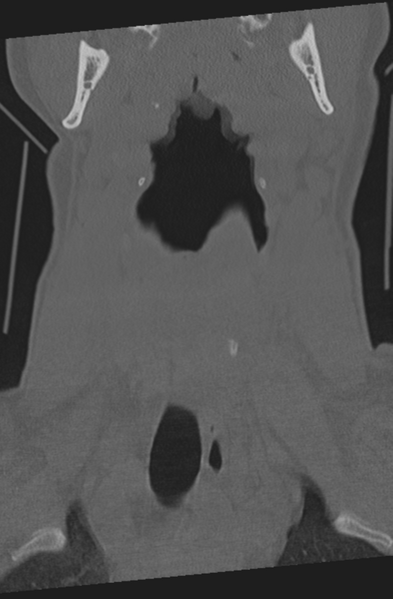 File:Axis peg fracture (type 3) and atlas lateral mass (type 4) fracture (Radiopaedia 37474-39324 Coronal bone window 5).png