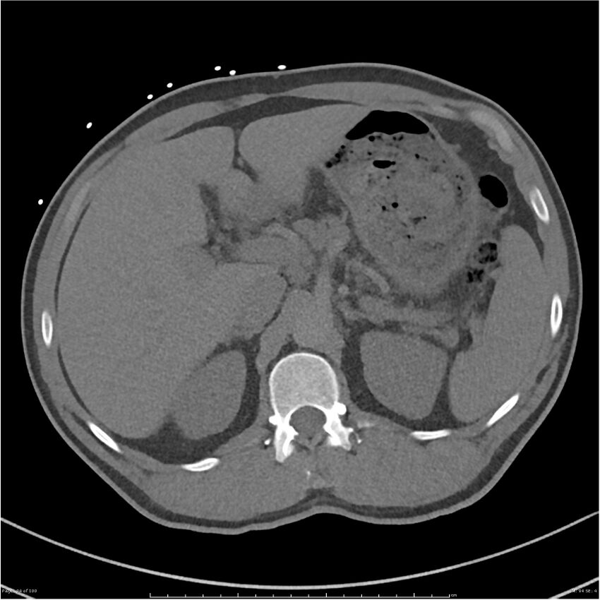 Azygos venous system anatomy (CT pulmonary angiography) (Radiopaedia 25928-26077 Axial C+ CTPA 94).jpg