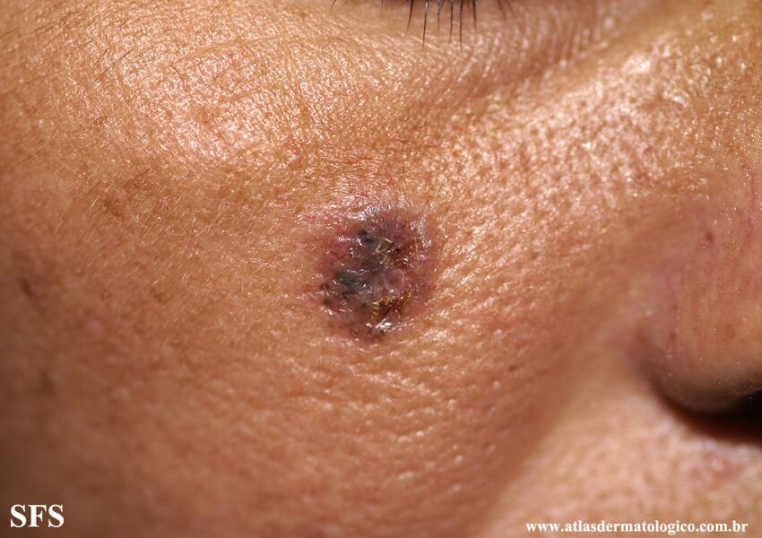 Basal Cell Carcinoma (Dermatology Atlas 312).jpg