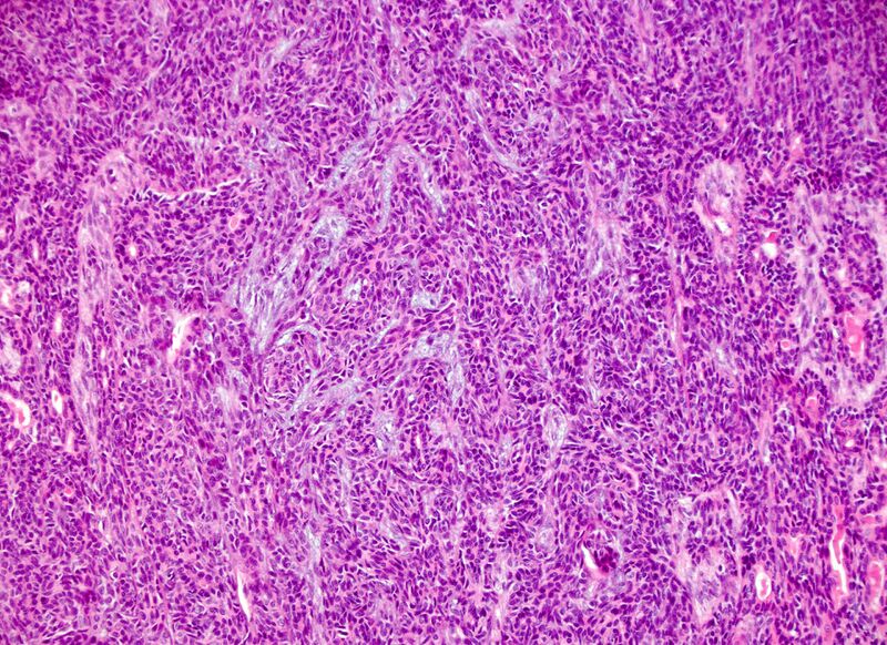 File:Basal cell adenoma - salivary gland (Radiopaedia 43989-47511 E 1).jpg