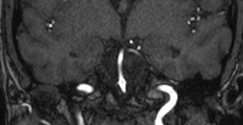 File:Basilar artery fenestration (Radiopaedia 74537-85455 Coronal MRA TOF 38).jpg
