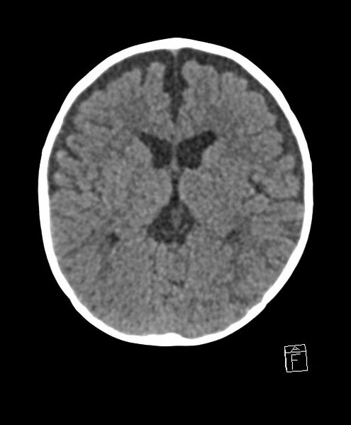 File:Benign enlargement of subarachnoid spaces in infancy (BESS) (Radiopaedia 87459-103795 Axial non-contrast 45).jpg