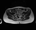 Bicornuate bicollis uterus (Radiopaedia 61626-69616 Axial T2 10).jpg