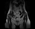 Bicornuate bicollis uterus (Radiopaedia 61626-69616 Coronal T2 4).jpg