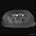 Bicornuate uterus- on MRI (Radiopaedia 49206-54297 Axial T1 fat sat 5).jpg