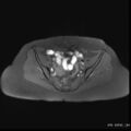 Bicornuate uterus- on MRI (Radiopaedia 49206-54297 Axial T1 fat sat 8).jpg