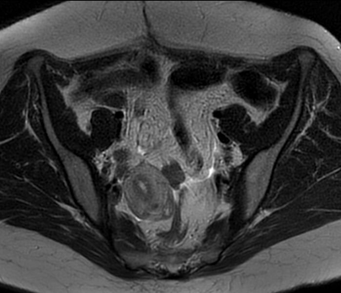 File:Bicornuate uterus (Radiopaedia 76407-88114 Axial T2 7).jpg