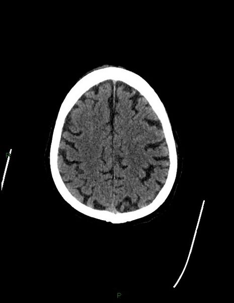 File:Bilateral acute middle cerebral artery territory infarcts (Radiopaedia 77319-89401 Axial non-contrast 68).jpg