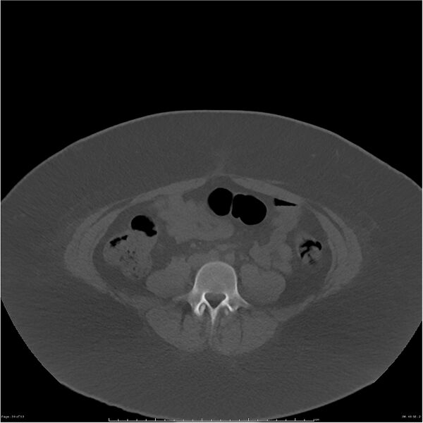 File:Bilateral lumbar ribs (Radiopaedia 25862-26010 bone window 34).jpg
