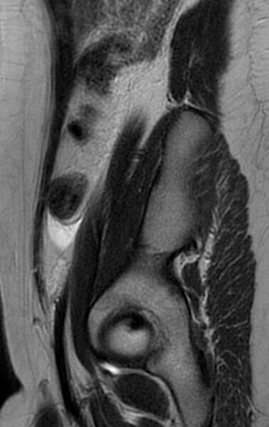 File:Bilateral ovarian fibrothecomas - adolescent (Radiopaedia 86604-102707 Sagittal T2 29).jpg