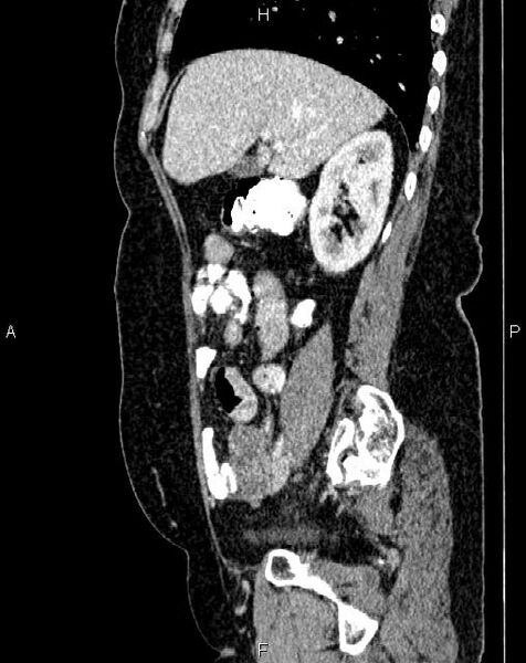 File:Bilateral ovarian serous cystadenocarcinoma (Radiopaedia 86062-101989 E 24).jpg