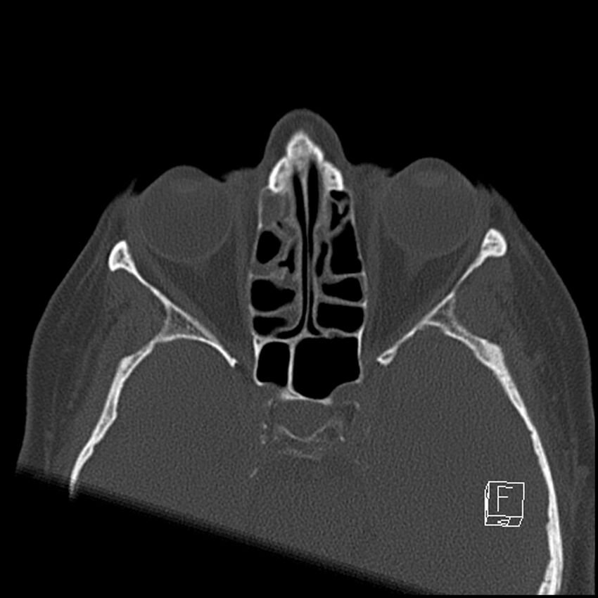 Bilateral palatine tonsilloliths on OPG and CT (Radiopaedia 75167-86247 Axial bone window 8).jpg