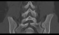 Bilateral pars defect (Radiopaedia 26691-26846 Coronal bone window 33).jpg