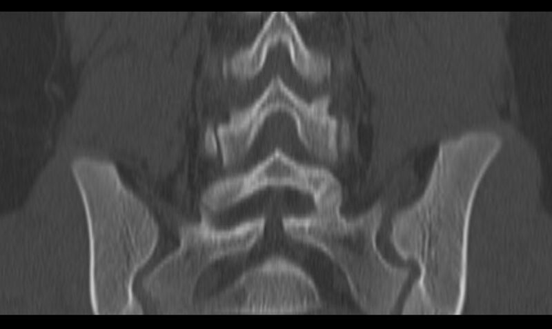 File:Bilateral pars defect (Radiopaedia 26691-26846 Coronal bone window 33).jpg
