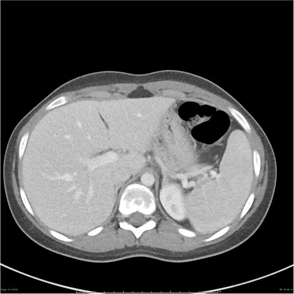 File:Bilateral ureteritis and cystitis (Radiopaedia 25340-25594 A 14).jpg