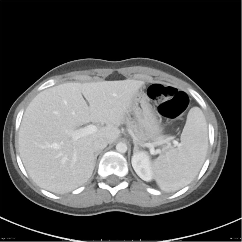 Bilateral ureteritis and cystitis (Radiopaedia 25340-25594 A 14).jpg