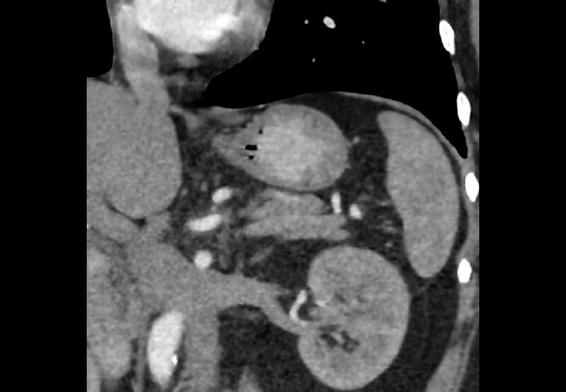 File:Bilateral urolithiasis with incidentally detected splenic artery aneurysm and left inferior vena cava (Radiopaedia 44467-48127 Ob. Cor. C+ Art. 22).jpg