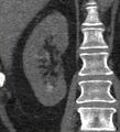 Bile leak from accessory duct(s) of Luschka post cholecystectomy (Radiopaedia 40736-43389 B 54).jpg